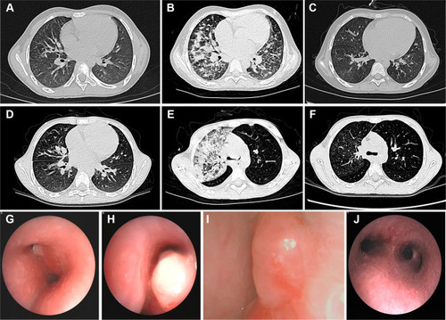 Figure 1 Chest radiographs and bronchoscopy images of patients A and B during the course of treatment. Chest CT images of patient A revealed: (A) small nodular opacities in both lungs; (B) pulmonary infiltrates; and (C) dissolution of pulmonary lesions. Chest CT images of patient B revealed: (D) enlarged mediastinal and peribronchial lymph nodes; (E) massive infiltration, consolidation, and atelectasis of the right upper lobe of the lungs; and (F) a nearly full recovery and dissolution of pulmonary infiltrates. Bronchoscopy images of patient B on (G, H) day 127 post-HSCT and (I) day 137 post-HSCT showing tubercular granulomas obstructing the airways. (J) Bronchoscopy images showing tubercular granulomas within the respiratory tract mucosa that did not regrow following two cryosurgeries. CT, computed tomography; HSCT, hematopoietic stem cell transplantation.