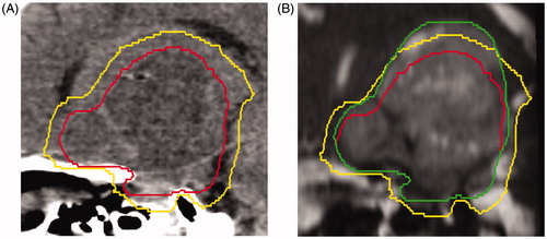 Figure 1. (A) Sagittal view of a computed tomography simulation scan with pretreatment gross tumor volume (GTV; red, inside line) and the 5-mm clinical target volume (CTV) expansion (yellow, outside line). (B) Mid-treatment balanced fast field-echo MRI with the pretreatment GTV (red, inside line), pretreatment 5-mm CTV expansion (yellow, middle line), and mid-treatment GTV contour (green, outside line) extending beyond the pretreatment CTV.