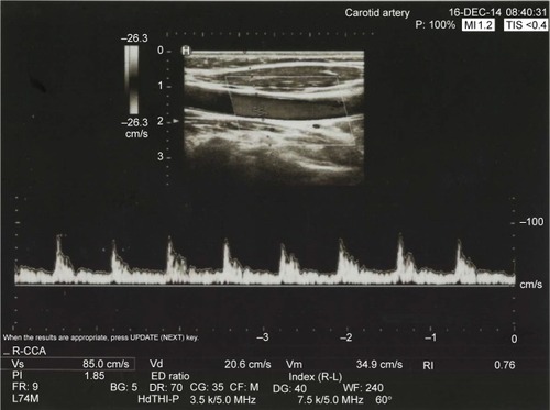 Figure 4 A Doppler ultrasound image of a 56-year-old female. There was no calcified carotid atheroma (Group B, control group).