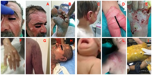 Figure 1 The examples of the chemical burns.