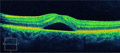 Figure 39 Cirrus™ optical coherence tomography.