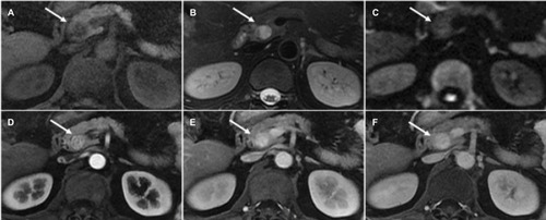 Figure 3 Magnetic resonance images of a 58-year-old woman with pancreatic neuroendocrine tumor Grade 1.Notes: Fat-suppressed liver acquisition with volume acceleration sequence. T1-(A) and T2-(B) weighted imaging, a well-defined mass (arrows) located in the uncinate process of pancreas shows hypo-intensity and hyper-intensity, respectively. Diffusion-weighted images shows the tumor (arrow) was isointense (C). The tumor (arrows) shows persistent hyper-enhancement during the arterial (D), portal venous (E), and delayed (F) phase.