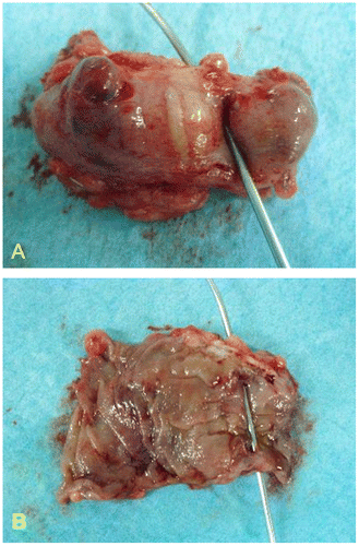 Figure 3. Resected specimen confirming penetration of the colon by the PEG tube: (A) serosal view, (B) mucosal view.