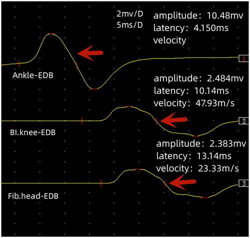 Figure 1. Nerve conduction graphs showing conduction block with decrease in amplitude and prolonged latency on proximal stimulation of peroneal nerve while distal conduction parameters are normal.