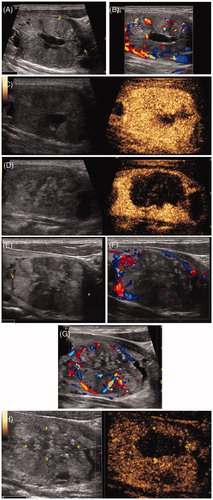 Figure 1. MWA treatment of a 35-year old man with a left thyroid solid nodule. (A) Two-dimensional ultrasonic image of the thyroid nodule. (B) The colour Doppler image of the thyroid nodule. (C) The contrast enhanced ultrasound image of the thyroid nodule before treatment. (D) The contrast enhanced ultrasound image of the nodule on day 3 after the ablation. (E) Two-dimensional ultrasonic image of the nodule three month after the ablation. (F) The colour Doppler image of the nodule three month after the ablation. Vascularity was shown around the nodule. (G) The colour Doppler image of the nodule six month after the ablation. Vascularity was shown inside the nodule in ablation area. (H) The contrast enhanced ultrasound image of the nodule six month after the ablation. Reperfusion was shown in the ablation area of the nodule.