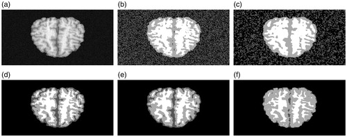 Figure 8. Experiment on real MRI image: (a) MRI image with noise. (b) FCM result. (c) FGFCM result. (d) FLICM result. (e) Proposed method result. (f) Ground truth.