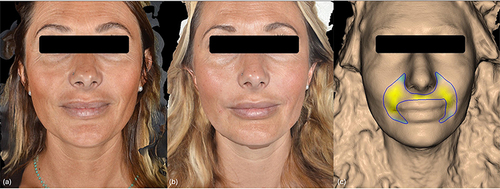 Figure 2 (a and b) Participant prior to receiving treatment as part of the study and immediately after. (c) Improvement of NLF with 3D facial reconstructions generated by QuantifiCare® software immediately following treatment.