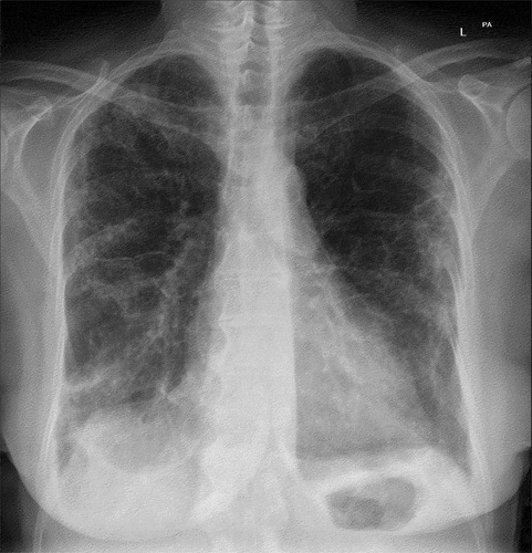 Figure 1. Chest X-ray showing bilateral scattered interstitial consolidations.