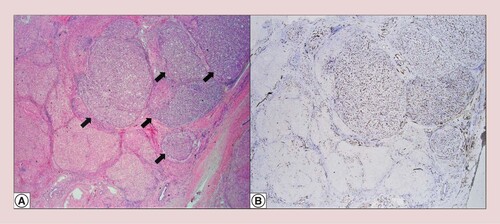 Figure 2. Microscopic features. Tumor nodules in a background of cirrhosis (arrows) (hematoxylin and eosin at 20× original magnification) (A). Sinusoidal capillarization pattern by CD34 (20× original magnification) (B).