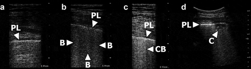 Figure 1. LUS findings in COVID-19 and corresponding score.A: the pleuraline (PL) appears normal. No B-lines or consolidation is present corresponding to a score of 1.B: multiple B-lines (B) origninating from the pleural line (PL). The B-lines involve less than 50% of the pleuraline, corresponding to a score of 2.C: multiple confluent B-lines (CB) are present. More than 50% of the pleural line are involved corresponding to a score of 3.D: A small subpleural consolidation (C) is present just below the pleural line, corresponding to a score of 4