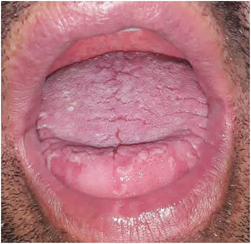Figure 6 Geographic tongue.