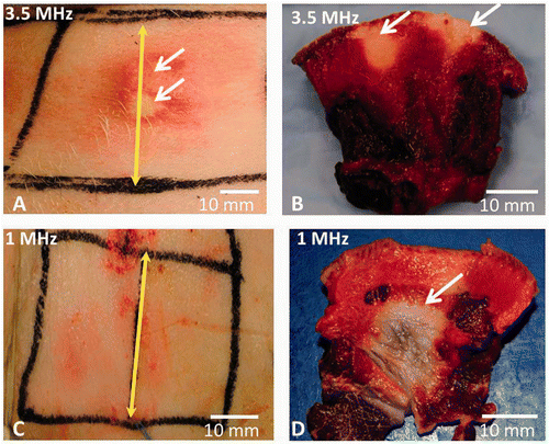 Figure 7. The skin of live pigs after thermal ablation with the SonoKnife using 100 W input power with either 3.5 or 1 MHz transducer for 50 and 300 seconds continuous sonication respectively. Skin cooling was done in both cases by placing an ice pack on the skin surface. The skin temperature was 8°C. (A) Skin burns (pointed with white arrows) seen immediately after ablation with 3.5 MHz SonoKnife transducer. (B) Skin burns in cross section after TTC staining (white arrows point towards the whitish non viable tissue). (C) The skin surface after therapy with 1 MHz SonoKnife transducer, where no skin burns were seen. (D) A subcutaneous thermal lesion is seen in cross section after TTC staining (white arrow points towards the non viable whitish tissue). The yellow double-headed arrow marks the centre of the Sonoknife transducer (along y axis).