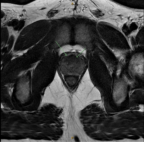 Figure 1 MRI image of the prostate lesion on axial T2-weighted imaging (green arrows indicate the lesion).