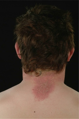 Figure 2 Posterior hairline involvement.