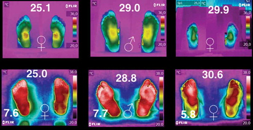 Figure 5. Six thermograms of the plantar skin. The three on the top corresponds to the individuals with BMI ≥ 25 kg/m2, while the three at the bottom are from the database of diabetic volunteers [Citation12]. The symbols ♀ and ♂ represent woman and man, respectively. The BMI of the individual is given at the central-top of each of the thermograms (given in kg/m2), and the HbA1c is given at the left-bottom for those thermograms of the diabetic patients.