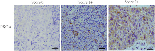 Figure 1 Expression of PKCα in NPC tissues. Representative images of PKCα staining in pathological specimens of NPC. The criteria for scores of 0 (left column), 1+ (middle column) and 2+ (right column) are described in the Materials and Methods (scale bar = 25 µm).