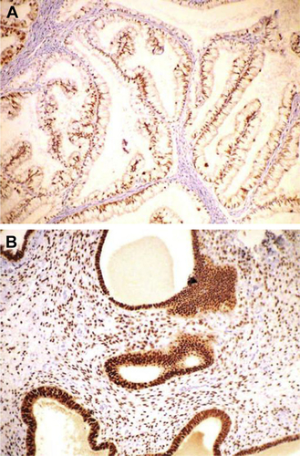 Figure S2 Immunohistochemical analysis of ER and PR expression in the glandular epithelium of endometrial polyp and endometrial cancer samples.