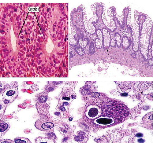 Figure 2. Colonoscopic biopsy.On above Left Image: Hematoxylin and eosin staining showing Cryptitis. On above right side: Hematoxylin and Eosin staining showing shortening of the crypts and Crypts Abscess – marked by Black Arrow. On below image: classic ‘owl eye inclusion bodies’ visualized on histology