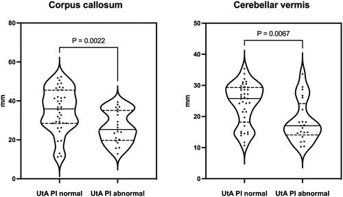 Figure 1. Violin plots showing distribution of corpus callosum and cerebellar vermis in growth restricted (FGR) fetuses with normal or abnormal uterine artery (UtA) PI. Circles represent individual points, horizontal lines indicate median (continuous), and interquartile range (IQR) (dotted). Comparison among groups was performed by Mann–Whitney U test.