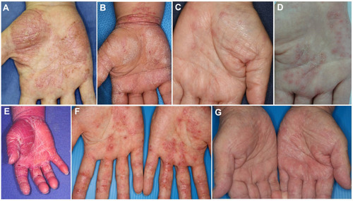 Figure 3 Various features affecting palms. (A) PPP, (B) psoriasis, (C) lichen planus, (D) dyshidrotic eczema, (E) pityriasis rubra pilaris, (F) contact dermatitis, (G) tinea manus.