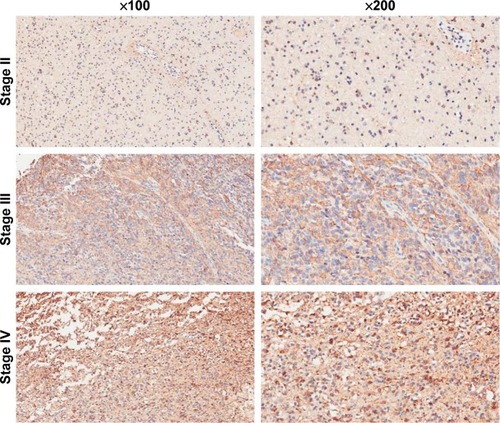 Figure 5 COX5B expression is overexpressed in different-grade II to IV glioma tissue. Magnification 200×.