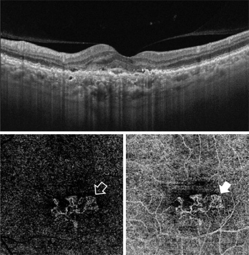 Figure 5 Upper, SS-OCT image of the left eye of a 66-year-old female with neovascular AMD shows multiple RPE detachments. The RPE in the sub-foveal area is irregular, thickened, and raised-up by a moderately hyper-reflective lesion associated with disorganization of the outer retina and accumulation of sub- and intra-retinal fluid, which indicates type I CNV. Lower, “en face” SS-OCTA image captured at the level of the outer retina (left) and choriocapillaris (right) in a 3×3 mm field. The extent of arborization of the neovascular complex is most revealed at the choriocapillaris projection (closed arrow head) compared to the outer retina projection (open arrow head).