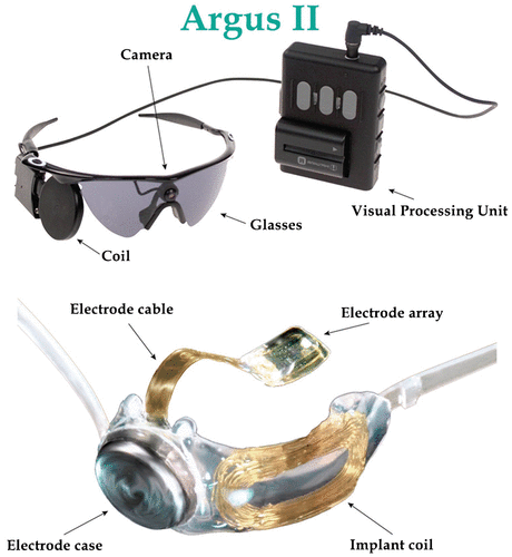 Figure 30. Argus II bionic system. Source: http://tekmono.com/teknoloji/1139/biyonik-goz-implanti-test-edild.