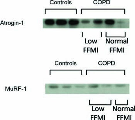 Figure 2.  Representative images of western blots for atrogin-1 and MuRF-1 protein in COPD patients and controls. The atrogin-1 band and MuRF-1 bands were seen on separate blots just below the 50 kDA marker. The atrogin bands are denser in the control samples than the COPD samples, with considerable variability between patients, while the MuRF-1 bands show no consistent density difference between COPD samples and controls.