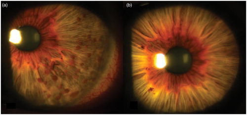 Figure 1. (a) Lisch nodules in the left eye, mainly located at the temporal portion; (b) no Lisch nodules are observed in the right iris.
