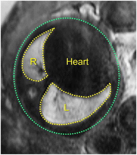 Figure 2. Fetal magnetic resonance imaging (MRI) showing an axial view of the fetal chest at the four-chambers view of the fetal heart with the measurements of the fetal right lung (R) and fetal left lung (L).