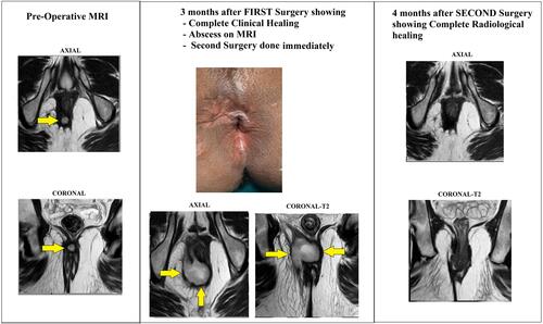 Figure 5 A 36-year-old male patient underwent surgery for a high intersphincteric fistula. Yellow arrows show the fistula tract/abscess. Left panel: preoperative MRI scans showing a high intersphincteric fistula. Middle panel: after 3 months of the first surgery, the fistula looked clinically healed with closed external opening (upper). However, the MRI scan revealed a large intersphincteric abscess (lower). The patient was operated on again. Right panel: MRI scan after 4 months of the second surgery shows complete radiological healing. The patient is doing well 18 months after the second surgery.