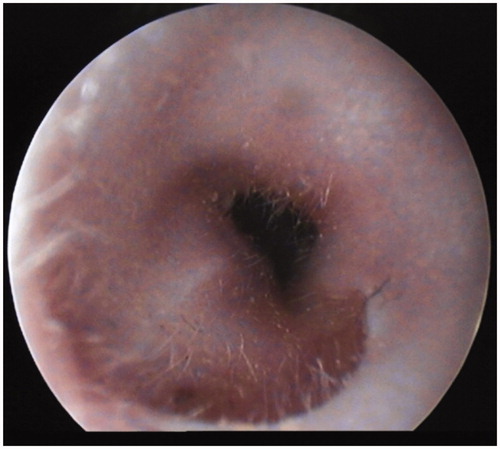 Figure 3. Postoperative otoscopic image. This otoscopic image was taken at 3 months follow-up.