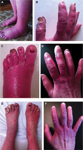 Figure 1 Erythematous feet (A) and hands (B) at baseline with firm, nodular lesions in the beginning stages of development. An example of extremities (C and D) during a symptom flare with progression of lesions to blisters and ulceration. Demonstration of feet (E) and hands (F) after successful treatment with clonidine and ketamine, and lesions in the process of healing.