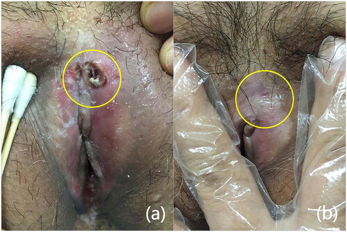 Figure 3. Side effects after FUS treatment and recovery from symptomatic treatment. (a) Ulcers appeared on the vulva after treatment, and the skin around the ulcers had become visibly red (yellow circle), (b) ulcers disappeared without scarring after one month of treatment (yellow circle).