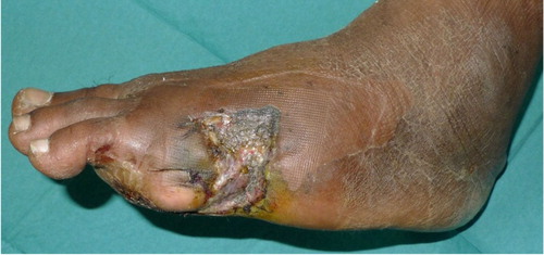 Fig. 5 Eight weeks post operation with the lesser toe fillet flap and split thickness skin graft fully incorporated.