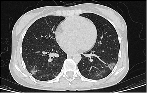 Figure 2 CT scan showed a thin ground-glass density shadow in both lungs, but it was slightly smaller than in previous scans.