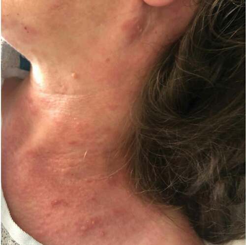 Figure 1. Painful vesicular rash across neck that spread to back consistent with herpes zoster