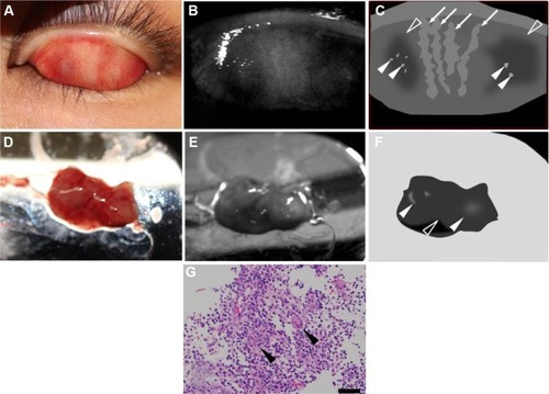 Figure 2 Case 1: a 32-year-old woman with chalazion.