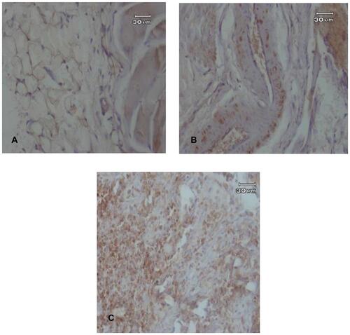 Figure 2 (A) Expression of type I collagen in tissue around implant with weak appearance; (B) expression of type I collagen in tissue around implant with moderate appearance; (C) expression of type I collagen in tissue around implants with strong appearance.