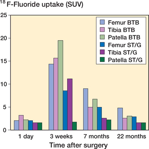 Figure 2. Individual fluoride uptake at the femoral and tibial tunnel areas, and also in the patella region. Values are presented as standardized uptake values (SUV).