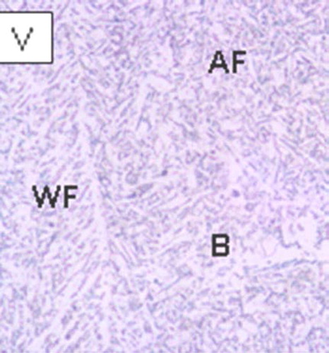 Figure 44. Optical micrograph showing Widmanstatten ferrite (WF), acicular ferrite (AF) and bainite (B) (after Ilman et al. [Citation252]).