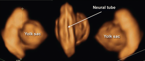 Figure 2.  3D reconstructed image of the yolk sac and 5.5 mm-CRL-embryo (6 weeks of gestation). Normal 6-week-embryo (CRL 5.5 mm) and yolk sac. Occipital view shows the neural tube on the embryonal back.