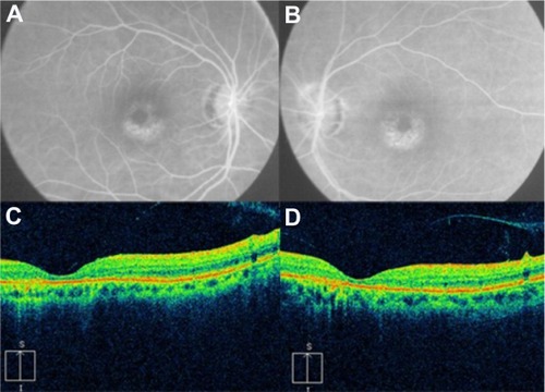 Figure 54 Fluorescein angiograms of the right (A) and left (B) eyes of a patient with hydroxychloroquine maculopathy. (C–D) Spectral domain Cirrus™ optical coherence tomography scans of the same two eyes.