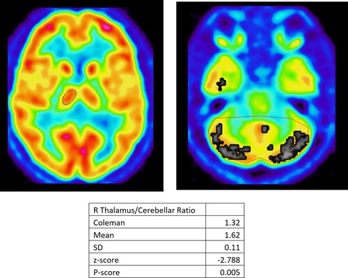 Figure 1. Diffusion Tensor Imaging (DTI) Statistical Analysis. DTI scans of the defendant were compared to scans of 12 age gender-matched controls. Regions of the defendant’s brain that have a significantly decreased Fractional Anisotropy (FA) value compared to controls were outlined in red, using Vinci. On the left, is the statistical analysis summary of the corresponding region. (A) Mr. Coleman’s anterior cingulate has an FA value of 0.18 compared to the control average FA value of 0.60. This is 11.73 standard deviations away from the average FA value of the control population’s anterior cingulate. (B) The defendant’s posterior cingulate has an FA value of 0.16 compared to the control average FA value of 0.58. This is 12.92 standard deviations away from the average FA value of the control population’s anterior cingulate. (C) The defendant’s pons has an FA value of 0.27 compared to the control average FA value of 0.53. This is 9.29 standard deviations away from the average FA value of the control population’s anterior cingulate. The statistically significant decreases in FA in the anterior cingulate, posterior cingulate, and pons are evidence of TBI.