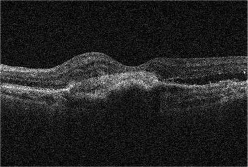 Figure 2 Case 2: Post-ranibizumab therapy: Cirrus OCT macular cube (512 × 128) showing sub-retinal fibrosis and foveal atrophy.