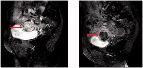 Figure 2. Pre- and post-HIFU MRI images obtained from a 71-year-old patient with pelvic recurrence and metastasis from ovarian cancer. (A). Pre-HIFU MRI image showed a lesion adjacent to the bladder. The size of the lesion was 33 cm × 42cm × 45cm with significantly enhancement (red arrow). (B). One month after HIFU, contrast-enhanced MR showed a non-enhanced area of 30 cm × 33cm × 36cm (arrow).