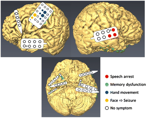 Figure 4. Speech was influenced by ECS only for the right precentral gyrus (Red). Finger movement was evoked from the motor areas (Purple). ECS evoked seizures when the facial area was stimulated (Yellow). Memory dysfunction was induced when the right temporal base was stimulated (Blue).