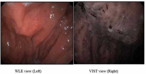 Figure 4. WLE view of patient with severe PHG during endoscopy session showing diffuse hemorrhagic red spots (Left) and VIST view with dilated capillaries surrounding gastric pits with areas of hemorrhage (Right).