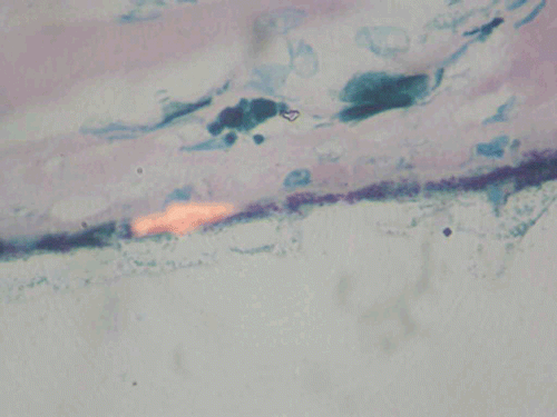 FIGURE 5  Microphotograph showing acid-fast bacilli in the retinal pigment epithelium using the Ziehl-Neelsen technique, ×100.
