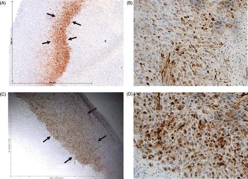 Figure 4. Effect of liposomal quercetin-RF on Hsp70 expression at 24 h. Tumour tissue from quercetin-RF (A, B) stained for Hsp70 demonstrates a comparatively weaker band of staining (black arrows) at the periphery of the ablation zone with a lower percentage of positive staining cells compared to RF alone (C, D), noting a persistent decrease in heat shock protein formation at 24 h. (A, C = 4×; B, D = 40×).